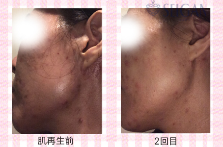 肌質改善・アンチエイジング・ニキビ・ニキビ跡（痕）FCRトリートメントビフォーアフター写真｜FCRハーブトリートメント｜50代・60代・70代から始めるエステ SEIGAN ｾｲｶﾞﾝ 【奥沢・自由が丘・田園調布】