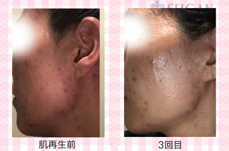 肌質改善・アンチエイジング・ニキビ・ニキビ跡（痕）FCRトリートメントビフォーアフター写真｜FCRハーブトリートメント｜50代・60代・70代から始めるエステ SEIGAN ｾｲｶﾞﾝ 【奥沢・自由が丘・田園調布】