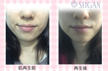 肌質改善・アンチエイジング・ニキビ・ニキビ跡（痕）FCRトリートメントビフォーアフター写真｜FCRハーブトリートメント｜50代・60代・70代から始めるエステ SEIGAN ｾｲｶﾞﾝ 【奥沢・自由が丘・田園調布】