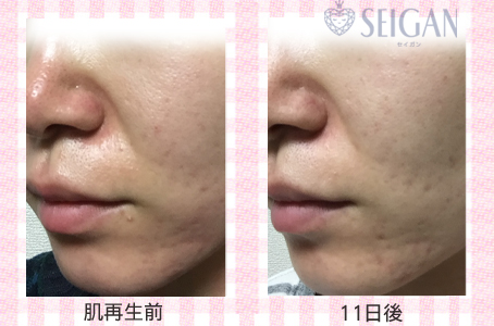 肌質改善・アンチエイジング・ニキビ・ニキビ跡（痕）FCRトリートメントビフォーアフター写真｜FCRハーブトリートメント｜50代・60代・70代から始めるエステ SEIGAN ｾｲｶﾞﾝ 【奥沢・自由が丘・田園調布】
