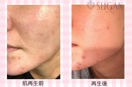 肌質改善・アンチエイジング・ニキビ・ニキビ跡（痕）FCRトリートメントビフォーアフター写真｜FCRハーブトリートメント｜50代・60代・70代から始めるエステ SEIGAN ｾｲｶﾞﾝ 【奥沢・自由が丘・田園調布】