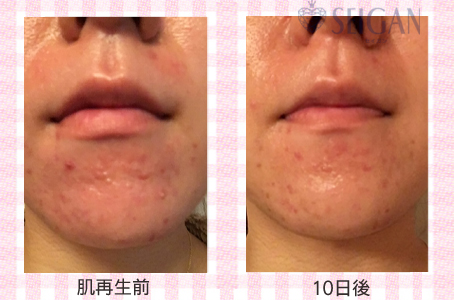 肌質改善・アンチエイジング・ニキビ・ニキビ跡（痕）FCRトリートメントビフォーアフター写真｜FCRハーブトリートメント｜50代・60代・70代から始めるエステ SEIGAN ｾｲｶﾞﾝ 【奥沢・自由が丘・田園調布】