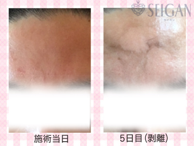 肌質改善・アンチエイジング・ニキビ・ニキビ跡（痕）FCRトリートメントビフォーアフター写真｜FCRハーブトリートメント｜50代・60代・70代から始めるエステ SEIGAN ｾｲｶﾞﾝ 【奥沢・自由が丘・田園調布】