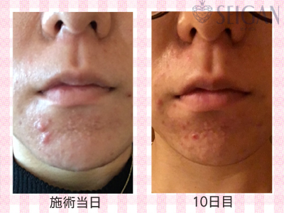 肌質改善・アンチエイジング・ニキビ・ニキビ跡（痕）FCRトリートメントビフォーアフター写真｜FCRハーブトリートメント｜50代・60代・70代から始めるエステ SEIGAN ｾｲｶﾞﾝ 【奥沢・自由が丘・田園調布】