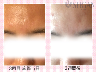 肌質改善・アンチエイジング・ニキビ・ニキビ跡（痕）FCRトリートメントビフォーアフター写真｜FCRハーブトリートメント｜50代・60代・70代から始めるエステ SEIGAN ｾｲｶﾞﾝ 【奥沢・自由が丘・田園調布】