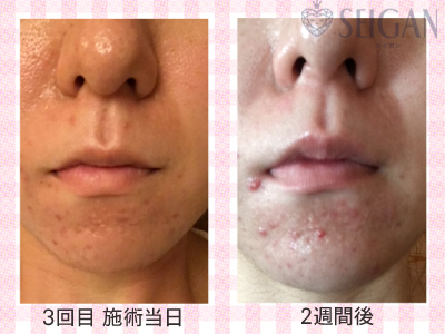 肌質改善・アンチエイジング・ニキビ・ニキビ跡（痕）FCRトリートメントビフォーアフター写真｜FCRハーブトリートメント｜50代・60代・70代から始めるエステ SEIGAN ｾｲｶﾞﾝ 【奥沢・自由が丘・田園調布】