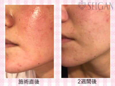 肌質改善・アンチエイジング・ニキビ・ニキビ跡（痕）FCRトリートメントビフォーアフター写真｜FCRハーブトリートメント｜50代・60代・70代から始めるエステ SEIGAN ｾｲｶﾞﾝ 【奥沢・自由が丘・田園調布】