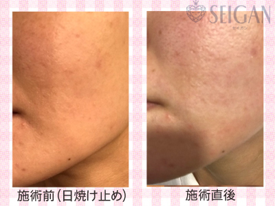 肌質改善・アンチエイジング・ニキビ・ニキビ跡（痕）FCRトリートメントビフォーアフター写真｜FCRハーブトリートメント｜50代・60代・70代から始めるエステ SEIGAN ｾｲｶﾞﾝ 【奥沢・自由が丘・田園調布】