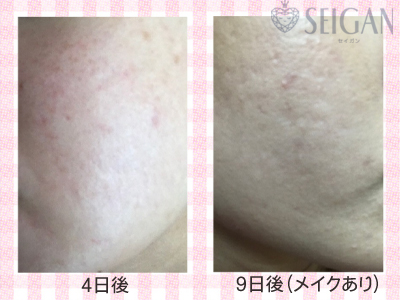 肌質改善・アンチエイジング・ニキビ・ニキビ跡（痕）FCRトリートメントビフォーアフター写真｜FCRハーブトリートメント｜50代・60代・70代から始めるエステ SEIGAN ｾｲｶﾞﾝ 【奥沢・自由が丘・田園調布】