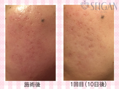肌質改善・アンチエイジング・ニキビ・ニキビ跡（痕）FCRトリートメントビフォーアフター写真｜FCRハーブトリートメント｜50代・60代・70代から始めるエステ SEIGAN ｾｲｶﾞﾝ 【奥沢・自由が丘・田園調布】