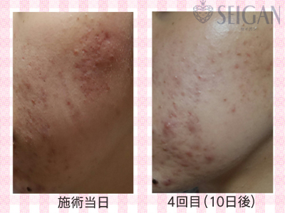 肌質改善・アンチエイジング・ニキビ・ニキビ跡（痕）FCRトリートメントビフォーアフター写真｜FCRハーブトリートメント｜50代・60代・70代から始めるエステ SEIGAN ｾｲｶﾞﾝ 【奥沢・自由が丘・田園調布】