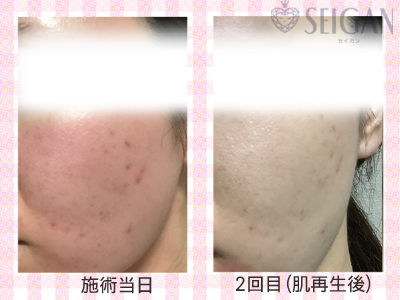 肌質改善・アンチエイジング・ニキビ・ニキビ跡（痕）FCRトリートメントビフォーアフター写真｜FCRハーブトリートメント｜50代・60代・70代から始めるエステ SEIGAN ｾｲｶﾞﾝ 【奥沢・自由が丘・田園調布】