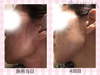 肌質改善・アンチエイジング・ニキビ・ニキビ跡（痕）FCRトリートメントビフォーアフター写真｜FCRハーブトリートメント｜50代・60代・70代から始めるエステ SEIGAN ｾｲｶﾞﾝ 【奥沢・自由が丘・田園調布】