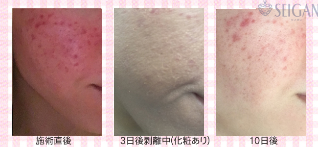 肌質改善・アンチエイジング・ニキビ・ニキビ跡（痕）FCRトリートメントビフォーアフター写真｜FCRハーブトリートメント｜50代・60代・70代から始めるエステ SEIGAN ｾｲｶﾞﾝ 【奥沢・自由が丘・田園調布】