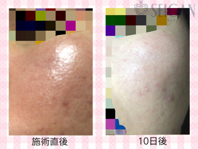 肌質改善・アンチエイジング・ニキビ・ニキビ跡（痕）FCRトリートメントビフォーアフター写真｜FCRハーブトリートメント｜50代・60代・70代から始めるエステ SEIGAN ｾｲｶﾞﾝ 【奥沢・自由が丘・田園調布】