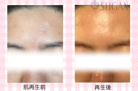 肌質改善・アンチエイジング・ニキビ・ニキビ跡（痕）FCRトリートメントビフォーアフター写真｜FCRハーブトリートメント｜50代・60代・70代から始めるエステ SEIGAN ｾｲｶﾞﾝ 【奥沢・自由が丘・田園調布】