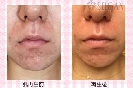 肌質改善・アンチエイジング・ニキビ・ニキビ跡（痕）FCRトリートメントビフォーアフター写真｜FCRハーブトリートメント｜50代・60代・70代から始めるエステ SEIGAN ｾｲｶﾞﾝ 【奥沢・自由が丘・田園調布】