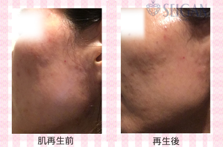 肌質改善・アンチエイジング・ニキビ・ニキビ跡（痕）FCRトリートメントビフォーアフター写真｜FCRハーブトリートメント｜50代・60代・70代から始めるエステ SEIGAN ｾｲｶﾞﾝ 【奥沢・自由が丘・田園調布】