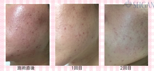 肌質改善・アンチエイジング・ニキビ・ニキビ跡（痕）FCRトリートメントビフォーアフター写真｜FCRハーブトリートメント｜50代・60代・70代から始めるエステ SEIGAN ｾｲｶﾞﾝ 【奥沢・自由が丘・田園調布】