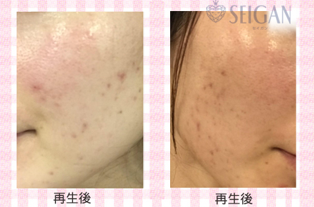肌質改善・アンチエイジング・ニキビ・ニキビ跡（痕）FCRトリートメントビフォーアフター写真｜FCRハーブトリートメント｜50代・60代・70代から始めるエステ SEIGAN ｾｲｶﾞﾝ 【奥沢・自由が丘・田園調布】