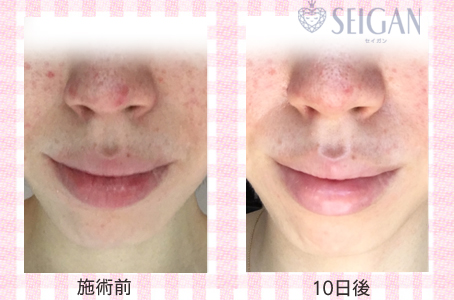 肌質改善・アンチエイジング・ニキビ・ニキビ跡（痕）FCRトリートメントビフォーアフター写真｜FCRハーブトリートメント｜50代・60代・70代から始めるエステ SEIGAN ｾｲｶﾞﾝ 【奥沢・自由が丘・田園調布】