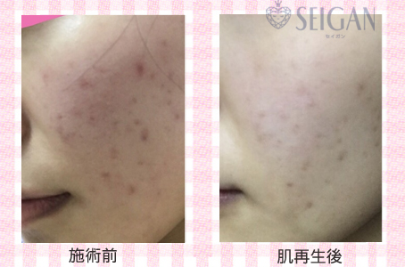 肌質改善・アンチエイジング・ニキビ・ニキビ跡（痕）FCRトリートメントビフォーアフター写真｜FCRハーブトリートメント｜50代・60代・70代から始めるエステ SEIGAN ｾｲｶﾞﾝ 【奥沢・自由が丘・田園調布】