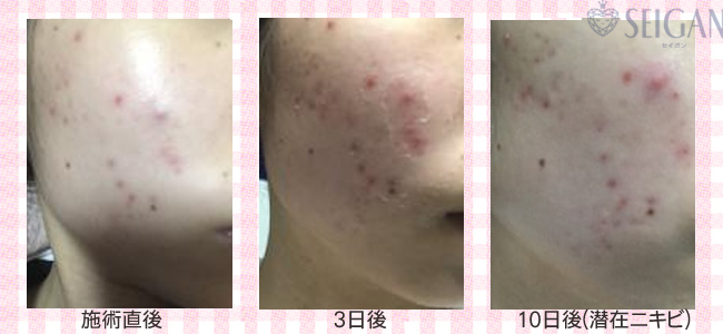 肌質改善・アンチエイジング・ニキビ・ニキビ跡（痕）FCRトリートメントビフォーアフター写真｜FCRハーブトリートメント｜50代・60代・70代から始めるエステ SEIGAN ｾｲｶﾞﾝ 【奥沢・自由が丘・田園調布】