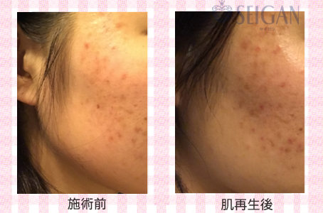 肌質改善・アンチエイジング・ニキビ・ニキビ跡（痕）FCRトリートメントビフォーアフター写真｜FCRハーブトリートメント｜50代・60代・70代から始めるエステ SEIGAN ｾｲｶﾞﾝ 【奥沢・自由が丘・田園調布】