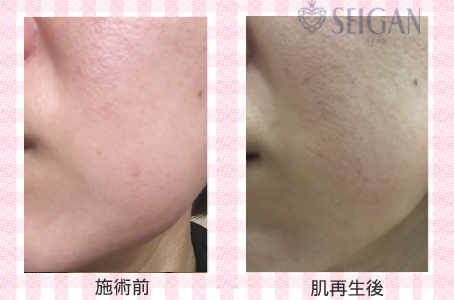 肌質改善・アンチエイジング・ニキビ・ニキビ跡（痕）FCRトリートメントビフォーアフター写真｜FCRハーブトリートメント｜50代・60代・70代から始めるエステ SEIGAN ｾｲｶﾞﾝ 【奥沢・自由が丘・田園調布】