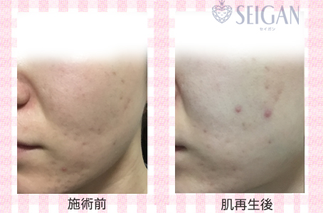 肌質改善・アンチエイジング・ニキビ・ニキビ跡（痕）FCRトリートメントビフォーアフター写真｜FCRハーブトリートメント｜50代・60代・70代から始めるエステ SEIGAN ｾｲｶﾞﾝ 【奥沢・自由が丘・田園調布】