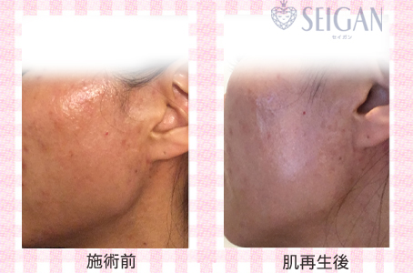肌質改善・アンチエイジング・ニキビ・ニキビ跡（痕）FCRトリートメントビフォーアフター写真｜FCRハーブトリートメント｜50代・60代・70代から始めるエステ SEIGAN ｾｲｶﾞﾝ 【奥沢・自由が丘・田園調布】