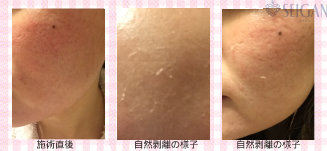 肌質改善・アンチエイジング・ニキビ・ニキビ跡（痕）FCRトリートメントビフォーアフター写真｜FCRハーブトリートメント｜50代・60代・70代から始めるエステ SEIGAN ｾｲｶﾞﾝ 【奥沢・自由が丘・田園調布】