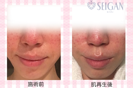肌質改善・アンチエイジング・ニキビ・ニキビ跡（痕）FCRトリートメントビフォーアフター写真｜FCRハーブトリートメント｜50代・60代・70代から始めるエステ SEIGAN ｾｲｶﾞﾝ 【奥沢・自由が丘・田園調布】