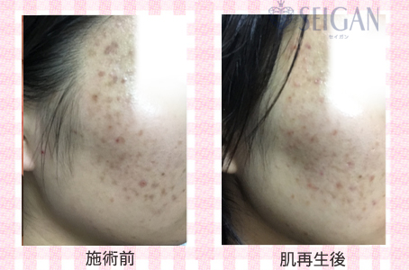肌質改善・アンチエイジング・ニキビ・ニキビ跡（痕）FCRトリートメントビフォーアフター写真｜FCRハーブトリートメント｜50代・60代・70代から始めるエステ SEIGAN ｾｲｶﾞﾝ 【奥沢・自由が丘・田園調布】