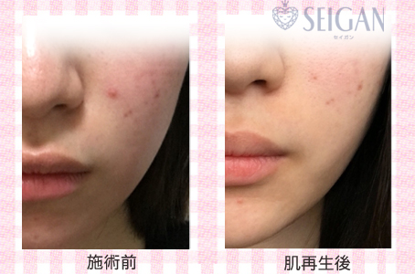 肌質改善・アンチエイジング・ニキビ・ニキビ跡（痕）FCRトリートメントビフォーアフター写真｜FCRハーブトリートメント｜50代・60代・70代から始めるエステ SEIGAN ｾｲｶﾞﾝ 【奥沢・自由が丘・田園調布】