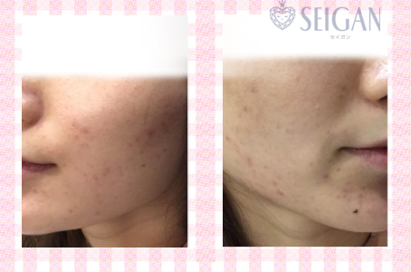 肌質改善・アンチエイジング・ニキビ・ニキビ跡（痕）FCRトリートメントビフォーアフター写真｜FCRハーブトリートメント｜50代・60代・70代から始めるエステ SEIGAN ｾｲｶﾞﾝ 【奥沢・自由が丘・田園調布】