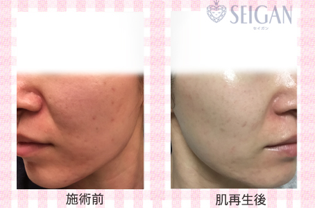 肌質改善・アンチエイジング・ニキビ・ニキビ跡（痕）FCRトリートメントビフォーアフター写真｜FCRハーブトリートメント｜50代・60代・70代から始めるエステ SEIGAN ｾｲｶﾞﾝ 【奥沢・自由が丘・田園調布】