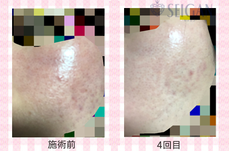 肌質改善・アンチエイジング・ニキビ・ニキビ跡（痕）FCRトリートメントビフォーアフター写真｜FCRハーブトリートメント｜50代・60代・70代から始めるエステ SEIGAN ｾｲｶﾞﾝ 【奥沢・自由が丘・田園調布】