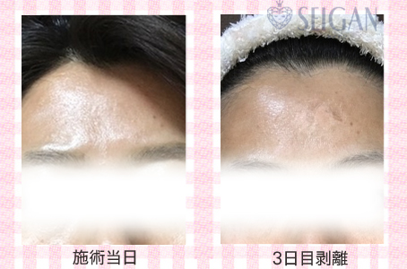 肌質改善・アンチエイジング・ニキビ・ニキビ跡（痕）FCRトリートメントビフォーアフター写真｜FCRハーブトリートメント｜50代・60代・70代から始めるエステ SEIGAN ｾｲｶﾞﾝ 【奥沢・自由が丘・田園調布】