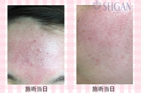 肌質改善・アンチエイジング・ニキビ・ニキビ跡（痕）FCRトリートメントビフォーアフター写真｜FCRハーブトリートメント｜50代・60代・70代から始めるエステ SEIGAN ｾｲｶﾞﾝ 【奥沢・自由が丘・田園調布】
