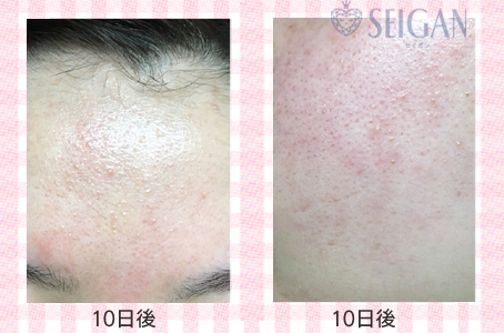 肌質改善・アンチエイジング・ニキビ・ニキビ跡（痕）FCRトリートメントビフォーアフター写真｜FCRハーブトリートメント｜50代・60代・70代から始めるエステ SEIGAN ｾｲｶﾞﾝ 【奥沢・自由が丘・田園調布】