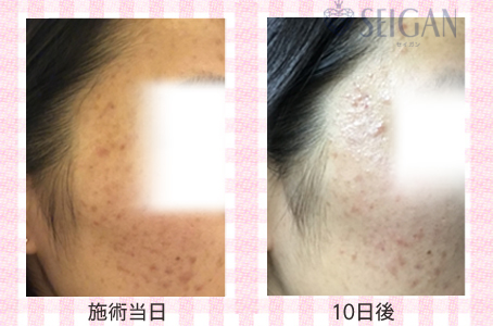 肌質改善・アンチエイジング・ニキビ・ニキビ跡（痕）FCRトリートメントビフォーアフター写真｜FCRハーブトリートメント｜50代・60代・70代から始めるエステ SEIGAN ｾｲｶﾞﾝ 【奥沢・自由が丘・田園調布】