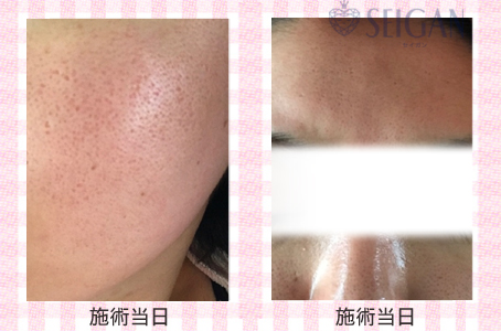 肌質改善・アンチエイジング・ニキビ・ニキビ跡（痕）FCRトリートメントビフォーアフター写真｜FCRハーブトリートメント｜50代・60代・70代から始めるエステ SEIGAN ｾｲｶﾞﾝ 【奥沢・自由が丘・田園調布】