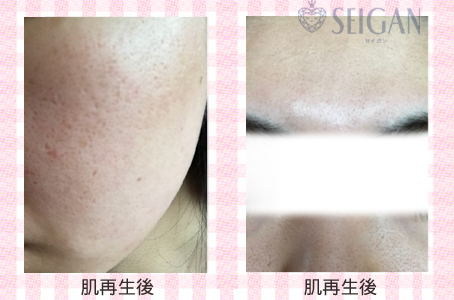 肌質改善・アンチエイジング・ニキビ・ニキビ跡（痕）FCRトリートメントビフォーアフター写真｜FCRハーブトリートメント｜50代・60代・70代から始めるエステ SEIGAN ｾｲｶﾞﾝ 【奥沢・自由が丘・田園調布】