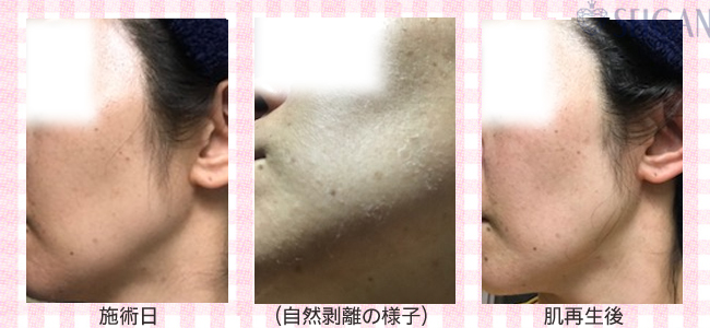 肌質改善・アンチエイジング・ニキビ・ニキビ跡（痕）FCRトリートメントビフォーアフター写真｜FCRハーブトリートメント｜50代・60代・70代から始めるエステ SEIGAN ｾｲｶﾞﾝ 【奥沢・自由が丘・田園調布】