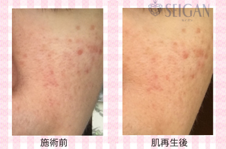 肌質改善・アンチエイジング・ニキビ・ニキビ跡（痕）FCRトリートメントビフォーアフター写真｜FCRハーブトリートメント｜50代・60代・70代から始めるエステ SEIGAN ｾｲｶﾞﾝ 【奥沢・自由が丘・田園調布】