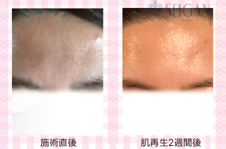 肌質改善・アンチエイジング・ニキビ・ニキビ跡（痕）FCRトリートメントビフォーアフター写真｜FCRハーブトリートメント｜50代・60代・70代から始めるエステ SEIGAN ｾｲｶﾞﾝ 【奥沢・自由が丘・田園調布】