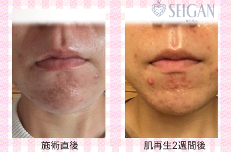 肌質改善・アンチエイジング・ニキビ・ニキビ跡（痕）FCRトリートメントビフォーアフター写真｜FCRハーブトリートメント｜50代・60代・70代から始めるエステ SEIGAN ｾｲｶﾞﾝ 【奥沢・自由が丘・田園調布】