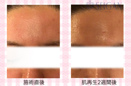 肌質改善・アンチエイジング・ニキビ・ニキビ跡（痕）FCRトリートメントビフォーアフター写真｜FCRハーブトリートメント｜50代・60代・70代から始めるエステ SEIGAN ｾｲｶﾞﾝ 【奥沢・自由が丘・田園調布】