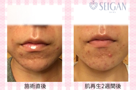 肌質改善・アンチエイジング・ニキビ・ニキビ跡（痕）FCRトリートメントビフォーアフター写真｜FCRハーブトリートメント｜50代・60代・70代から始めるエステ SEIGAN ｾｲｶﾞﾝ 【奥沢・自由が丘・田園調布】